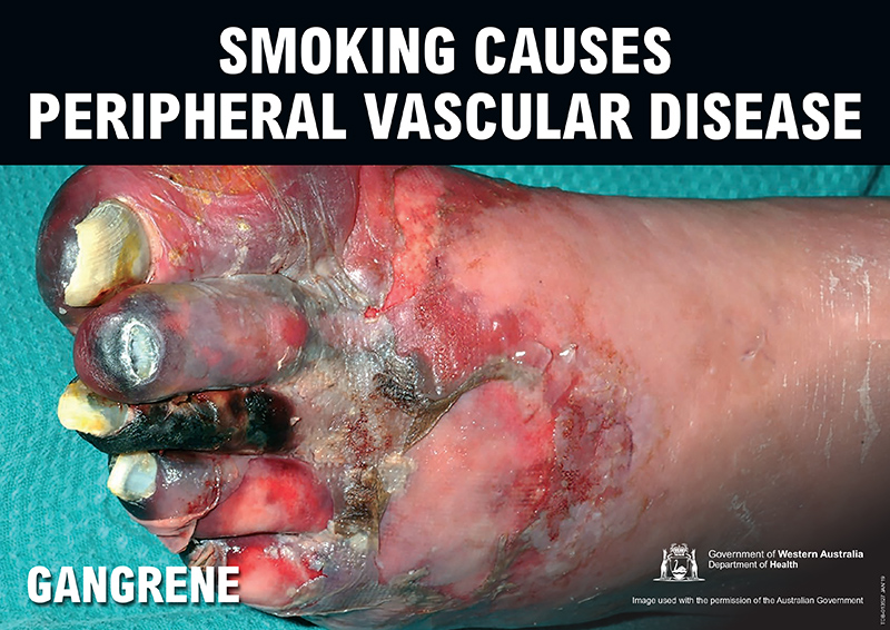 Banner: smoking causes peripheral vascular disease