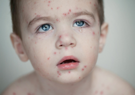 Boy with chicken pox