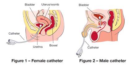 Diagram showing cross-section of both female and male abdomen with catheter inserted into the bladder, via the urethra