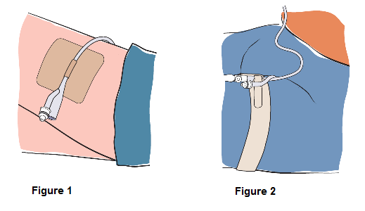Figure 3 and 4 Diagram showing a catheter attached a person’s upper thigh using an adhesive
