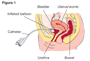 Diagram of cross-section of female with a catheter inserted through the abdomen