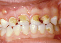 A young child’s mouth showing yellowed and crumbling teeth – a sign of advanced early childhood dental decay. 