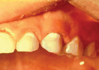 An infant’s teeth showing white spots on the gum line, which is an early sign of decay