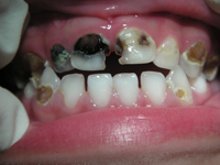 Teeth showing black and yellow tooth decay