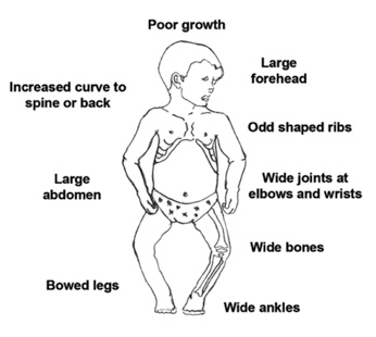 diagram of a young child with rickets indicating the symptoms of the disease