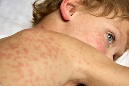 Measles rash on a boys chest