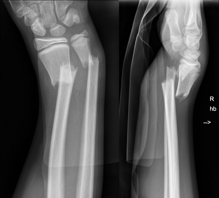 Displaced wrist