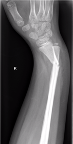 Galeazzi fracture dislocation