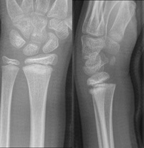 Salter-Harris 1 fracture of distal radius