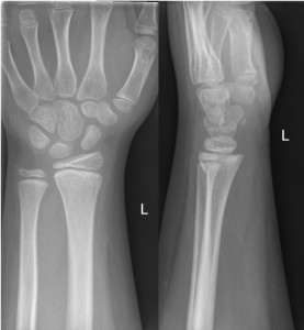 Undisplaced Salter-Harris II fracture of distal radius