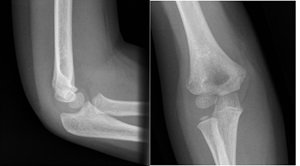 Undisplaced supracondylar fracture