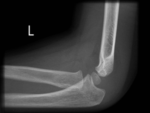 Undisplaced supracondylar fracture