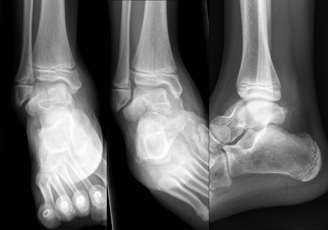 Fracture of neckof talus